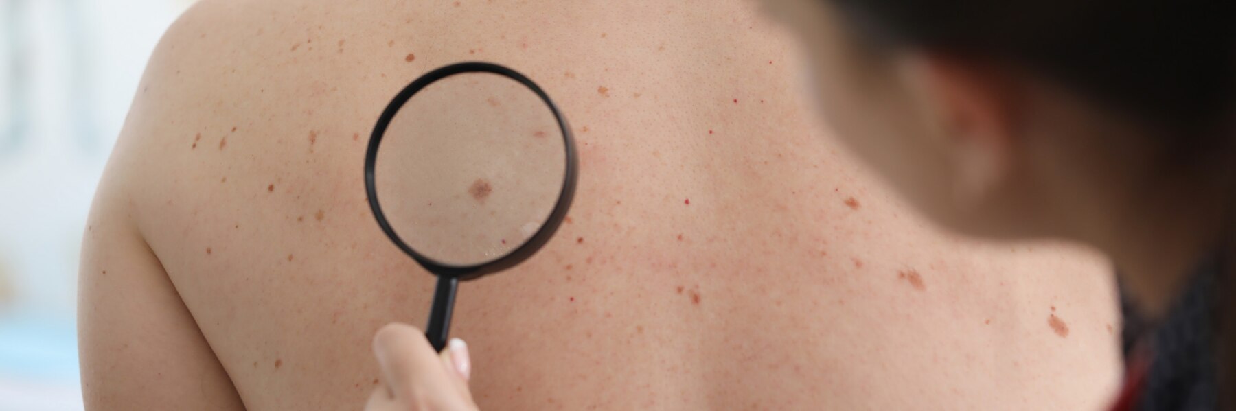 doctor-looks-through-magnifying-glass-mole-patient_151013-11676.jpg